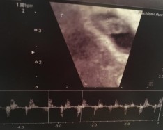 Baby 1's Amazing Heartbeat